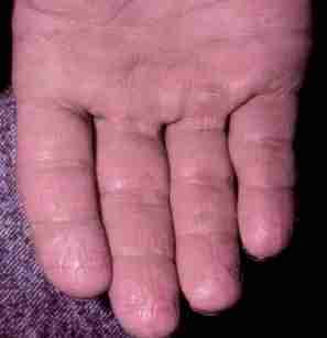 Photograph of a hand showing signs of dermatitis
