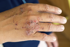 Dermatitis Dematitis